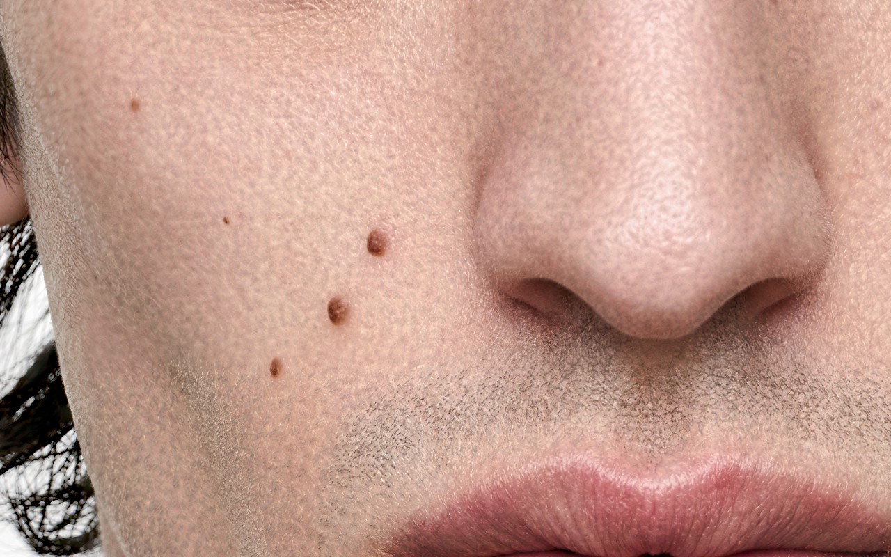 Cheek, grain scale 4.5 — blotchy